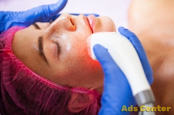 Laser For Rosacea Treatment Orlando