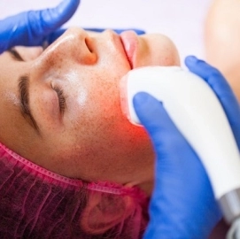 Laser For Rosacea Treatment Orlando